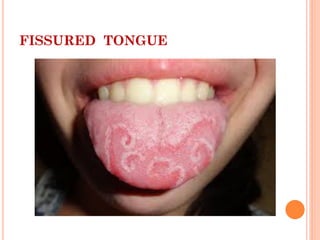 FISSURED TONGUE
 