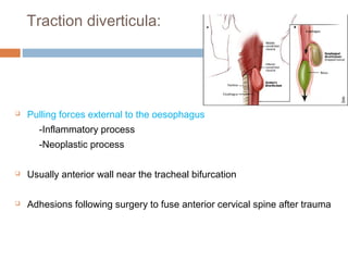 Traction diverticula:
 Pulling forces external to the oesophagus
-Inflammatory process
-Neoplastic process
 Usually anterior wall near the tracheal bifurcation
 Adhesions following surgery to fuse anterior cervical spine after trauma
 