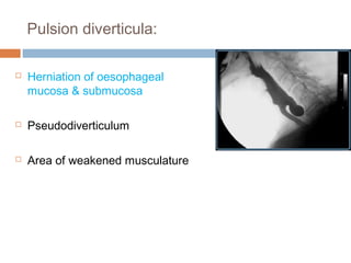 Pulsion diverticula:
 Herniation of oesophageal
mucosa & submucosa
 Pseudodiverticulum
 Area of weakened musculature
 
