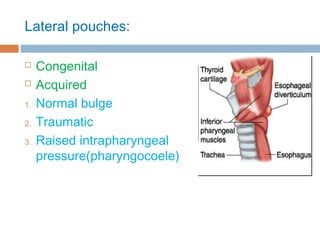 Lateral pouches:
 Congenital
 Acquired
1. Normal bulge
2. Traumatic
3. Raised intrapharyngeal
pressure(pharyngocoele)
 