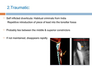 2.Traumatic:
 Self inflicted diverticula: Habitual criminals from India
Repetitive introduction of piece of lead into the tonsillar fossa
 Probably lies between the middle & superior constrictors
 If not maintained, disappears rapidly
 