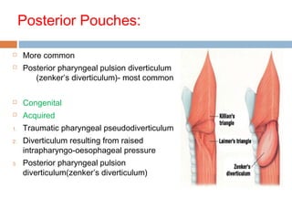 Posterior Pouches:
 More common
 Posterior pharyngeal pulsion diverticulum
(zenker’s diverticulum)- most common
 Congenital
 Acquired
1. Traumatic pharyngeal pseudodiverticulum
2. Diverticulum resulting from raised
intrapharyngo-oesophageal pressure
3. Posterior pharyngeal pulsion
diverticulum(zenker’s diverticulum)
 