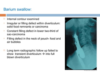 Barium swallow:
 Internal contour examined
 Irregular or filling defect within diverticulum:
solid food remnants or carcinoma
 Constant filling defect in lower two-third of
sac-carcinoma
 Filling defect in the neck of pouch- food and
air bubbles
 Long term radiographic follow up failed to
show transient diverticulum  into full
blown diverticulum
 