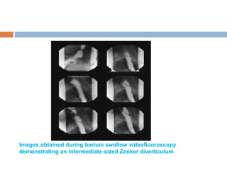 Images obtained during barium swallow videofluoroscopy
demonstrating an intermediate-sized Zenker diverticulum
 