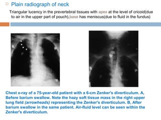  Plain radiograph of neck
Triangular lucency in the prevertebral tissues with apex at the level of cricoid(due
to air in the upper part of pouch),base has meniscus(due to fluid in the fundus)
Chest x-ray of a 75-year-old patient with a 6-cm Zenker's diverticulum. A,
Before barium swallow. Note the hazy soft tissue mass in the right upper
lung field (arrowheads) representing the Zenker's diverticulum. B, After
barium swallow in the same patient. Air-fluid level can be seen within the
Zenker's diverticulum.
 
