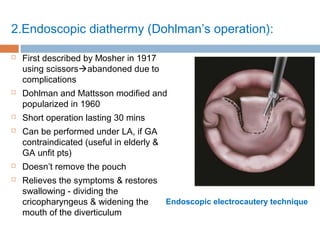 2.Endoscopic diathermy (Dohlman’s operation):
 First described by Mosher in 1917
using scissorsabandoned due to
complications
 Dohlman and Mattsson modified and
popularized in 1960
 Short operation lasting 30 mins
 Can be performed under LA, if GA
contraindicated (useful in elderly &
GA unfit pts)
 Doesn’t remove the pouch
 Relieves the symptoms & restores
swallowing - dividing the
cricopharyngeus & widening the
mouth of the diverticulum
Endoscopic electrocautery technique
 