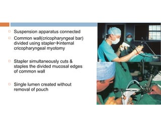  Suspension apparatus connected
 Common wall(cricopharyngeal bar)
divided using staplerinternal
cricopharyngeal myotomy
 Stapler simultaneously cuts &
staples the divided mucosal edges
of common wall
 Single lumen created without
removal of pouch
 