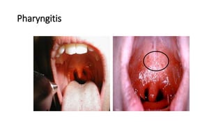 Pharyngitis | PPTX