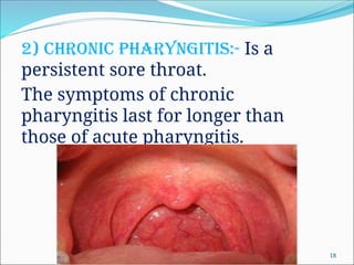 2) Chronic pharyngitis:- Is a
persistent sore throat.
The symptoms of chronic
pharyngitis last for longer than
those of acute pharyngitis.
18
 
