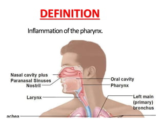 DEFINITION
Inflammationofthepharynx.
 