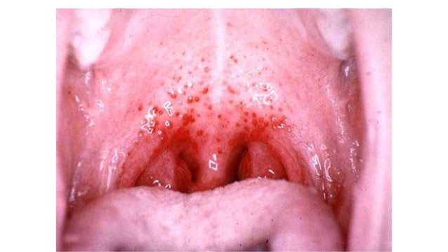 Pharyngitis, laryngitis
