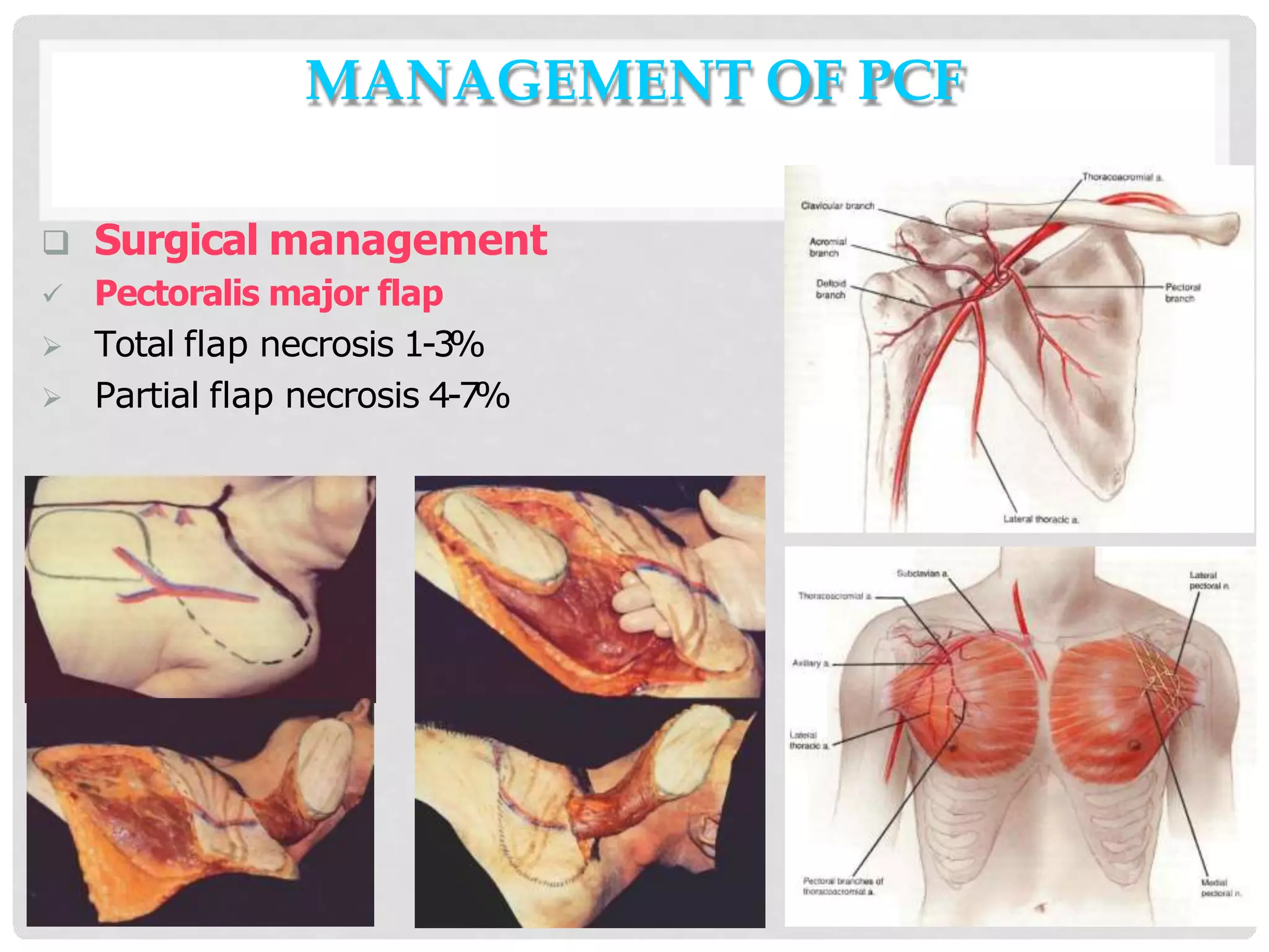Pcf Surgery Pharyngocutaneous-fistula (1).pptx