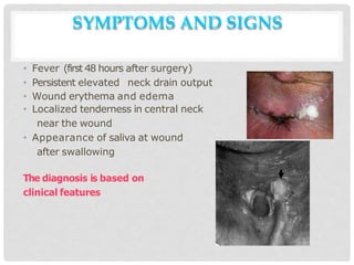 SYMPTOMS AND SIGNS
• Fever (first 48 hours after surgery)
• Persistent elevated neck drain output
• Wound erythema and edema
• Localized tenderness in central neck
near the wound
• Appearance of saliva at wound
after swallowing
The diagnosis is based on
clinical features
 