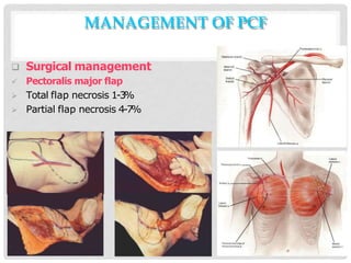 MANAGEMENT OF PCF
 Surgical management
 Pectoralis major flap
 Total flap necrosis 1-3%
 Partial flap necrosis 4-7%
 