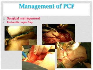 Management of PCF
 Surgical management
 Pectoralis major flap
 