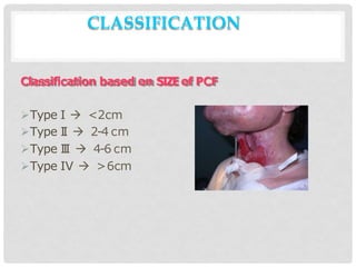 CLASSIFICATION
Classification based on SIZEof PCF
Type I  <2cm
Type I
I  2-4 cm
Type I
I
I  4-6 cm
Type IV  >6cm
 
