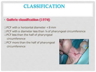 CLASSIFICATION
• Guthrie classification (1974)
PCF with a horizontal diameter <8 mm
PCF with a diameter less than ¼of pharyngeal circumference
PCF less than the half of pharyngeal
circumference
PCF more than the half of pharyngeal
circumference
 