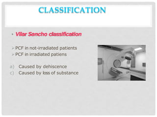 CLASSIFICATION
• Vilar Sancho classification
PCF in not-irradiated patients
PCF in irradiated patiens
a) Caused by dehiscence
c) Caused by loss of substance
 