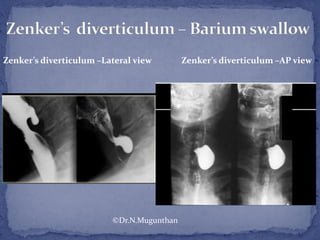 Zenker’s diverticulum –Lateral view Zenker’s diverticulum –AP view
©Dr.N.Mugunthan
 