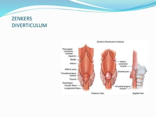 ZENKERS
DIVERTICULUM
 