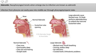 Adenoids: Nasopharyngeal tonsils when enlarge due to infection are known as adenoids
Infection from pharynx can easily pass into middle ear through pharyngotympanic tube.
 