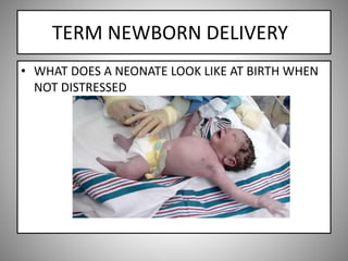 TERM NEWBORN DELIVERY
• WHAT DOES A NEONATE LOOK LIKE AT BIRTH WHEN
NOT DISTRESSED
 