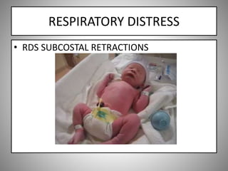 RESPIRATORY DISTRESS
• RDS SUBCOSTAL RETRACTIONS
 