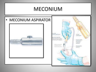 MECONIUM
• MECONIUM ASPIRATOR
 