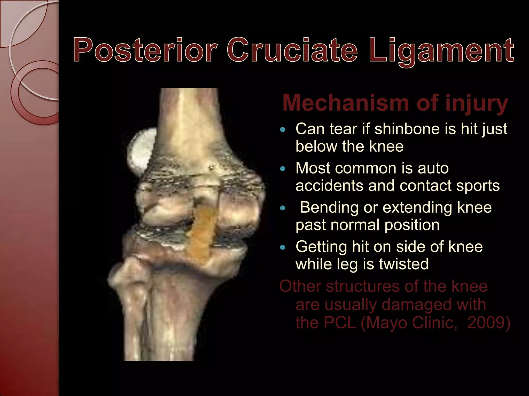 Posterior Cruciate LigamentMechanism of injuryCan tear if shinbone is hit just below the knee Most common is auto accidents and contact sports Bending or extending knee past normal positionGetting hit on side of knee while leg is twistedOther structures of the knee are usually damaged with the PCL (Mayo Clinic,  2009)