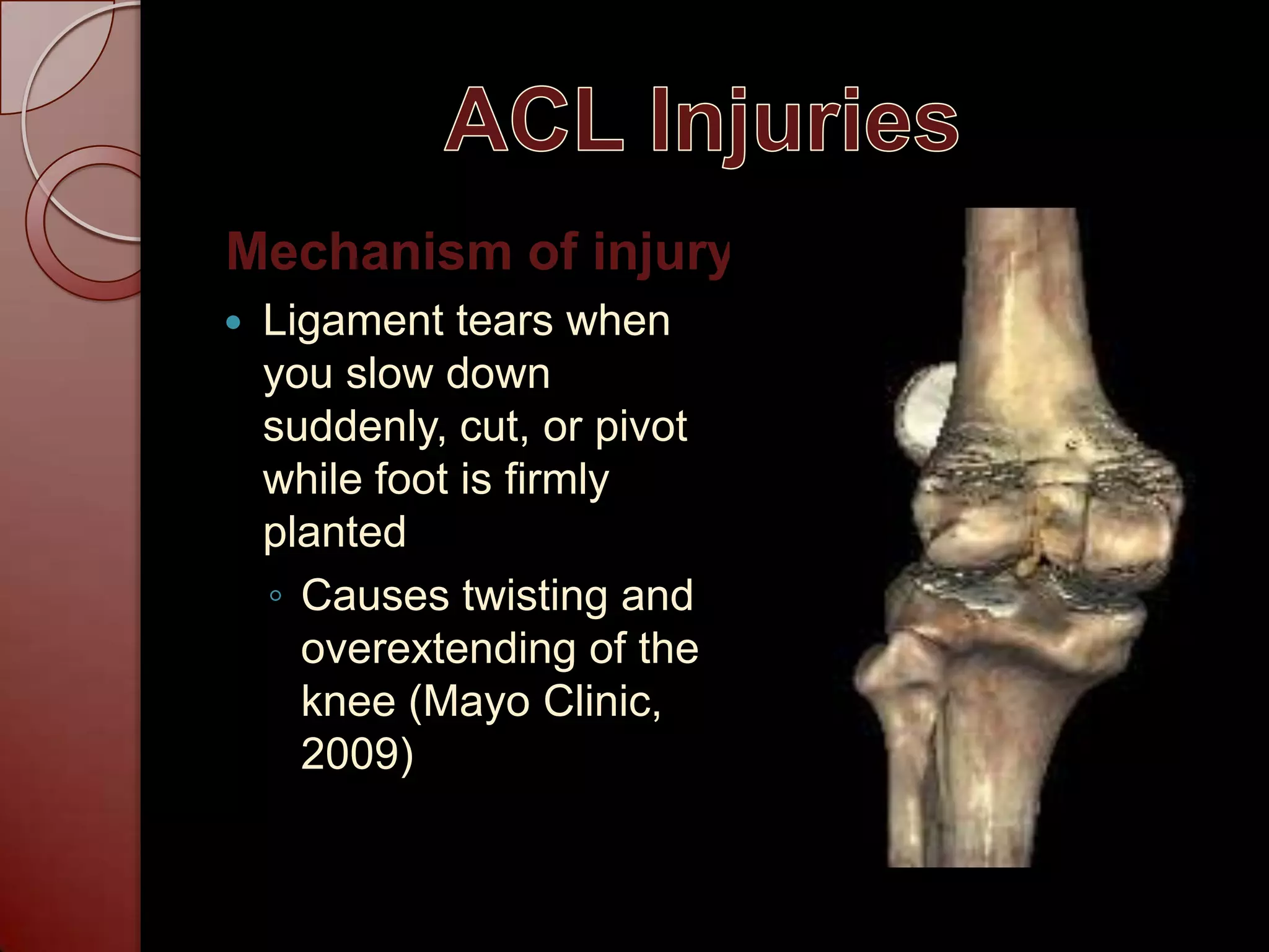 ACL Injuries Mechanism of injuryLigament tears when you slow down suddenly, cut, or pivot while foot is firmly plantedCauses twisting and overextending of the knee (Mayo Clinic, 2009)