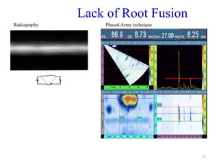 33
Lack of Root Fusion
Radiography Phased Array technique
 