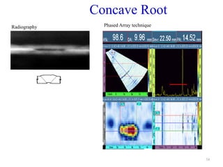 34
Concave Root
Radiography Phased Array technique
 
