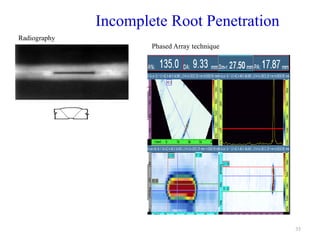 35
Incomplete Root Penetration
Radiography
Phased Array technique
 