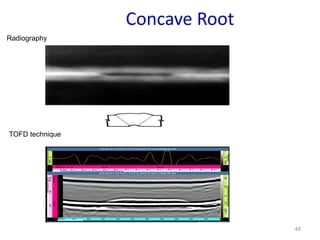 48
Concave Root
TOFD technique
Radiography
 