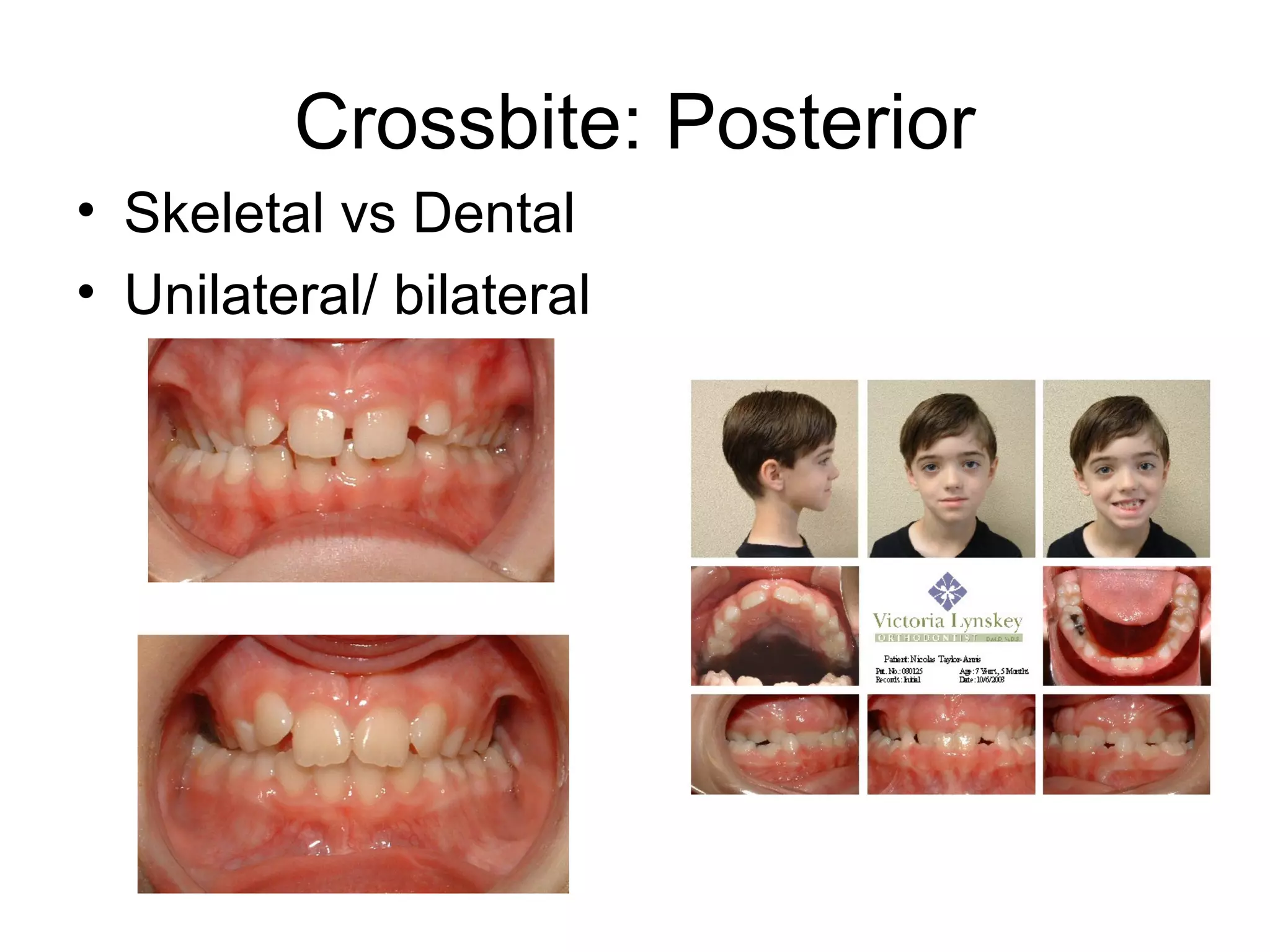 Left Crossbite Phase I Orthodontic treatment | PPT