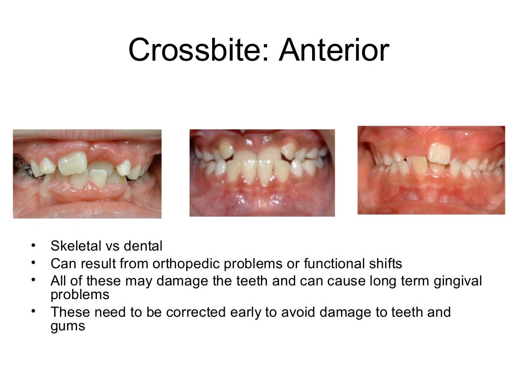 Phase I Orthodontic treatment