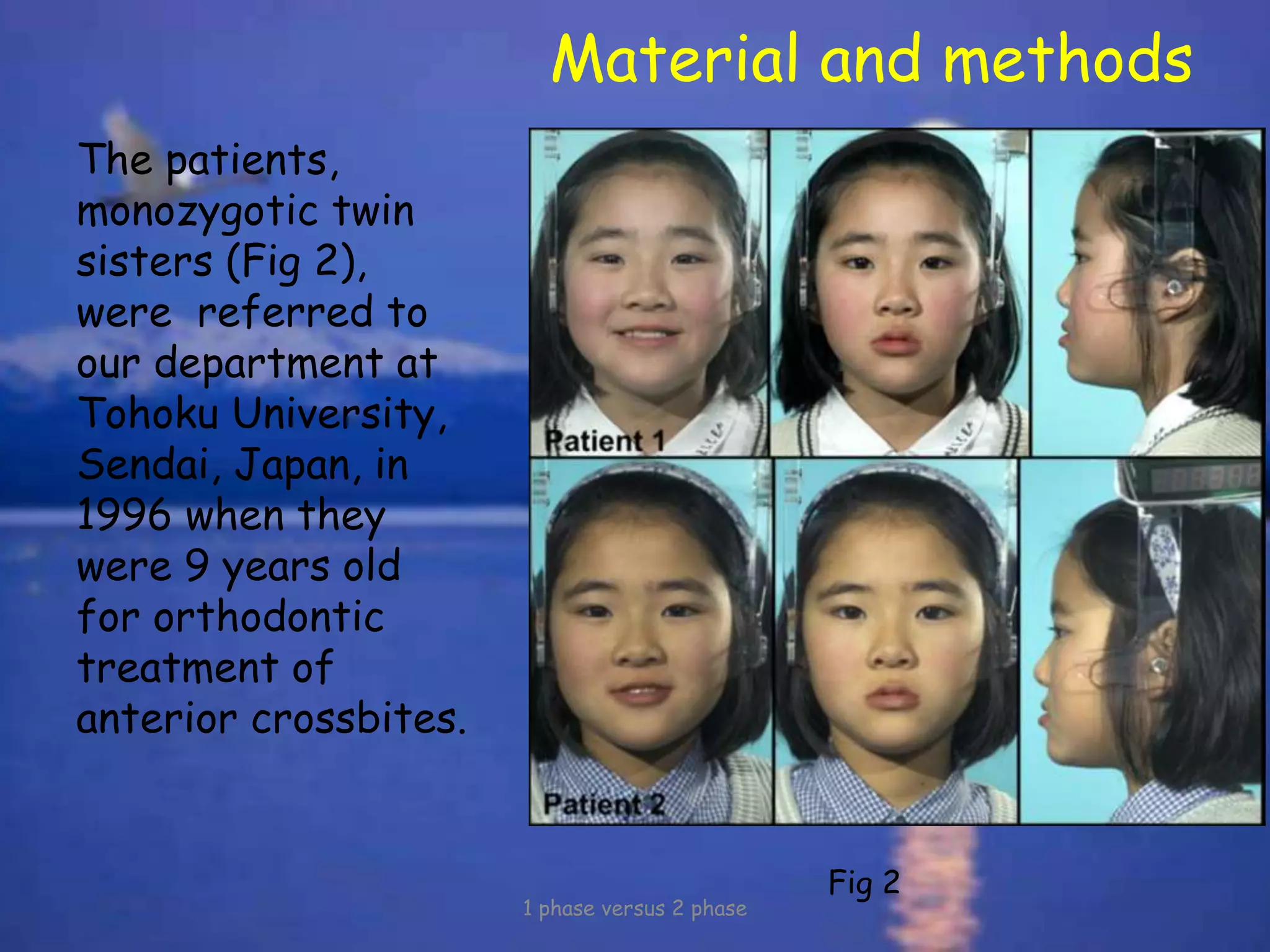 Material and methods
The patients,
monozygotic twin
sisters (Fig 2),
were referred to
our department at
Tohoku University,
Sendai, Japan, in
1996 when they
were 9 years old
for orthodontic
treatment of
anterior crossbites.
1 phase versus 2 phase
Fig 2
 