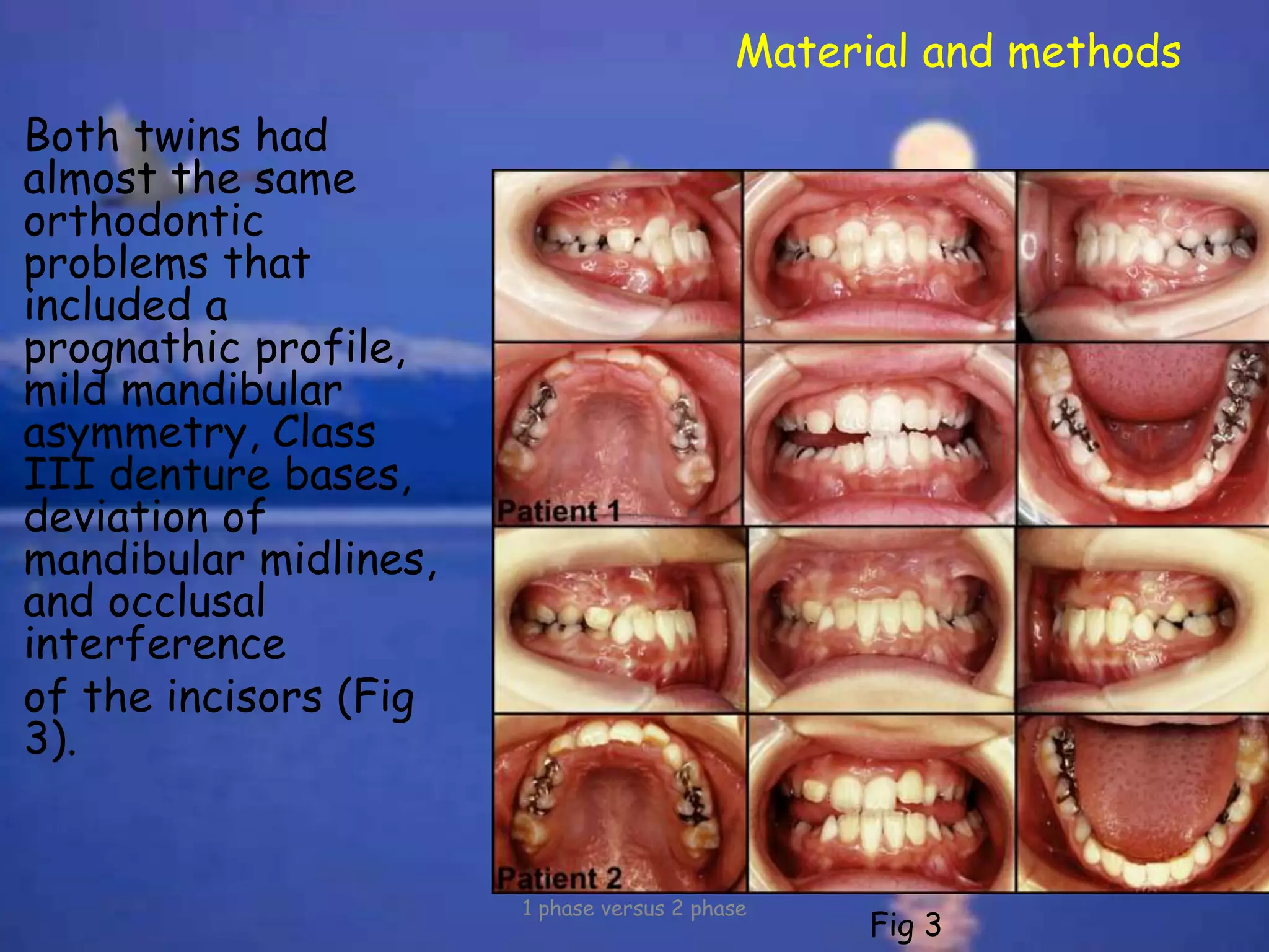 Material and methods
Both twins had
almost the same
orthodontic
problems that
included a
prognathic profile,
mild mandibular
asymmetry, Class
III denture bases,
deviation of
mandibular midlines,
and occlusal
interference
of the incisors (Fig
3).
1 phase versus 2 phase
Fig 3
 