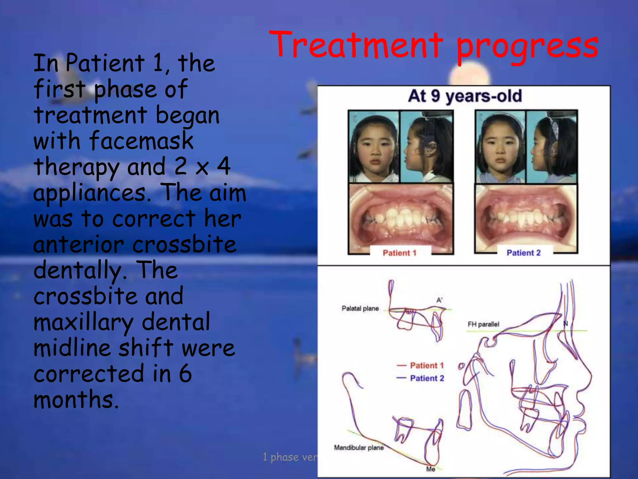 Treatment progressIn Patient 1, the
first phase of
treatment began
with facemask
therapy and 2 x 4
appliances. The aim
was to correct her
anterior crossbite
dentally. The
crossbite and
maxillary dental
midline shift were
corrected in 6
months.
1 phase versus 2 phase
 