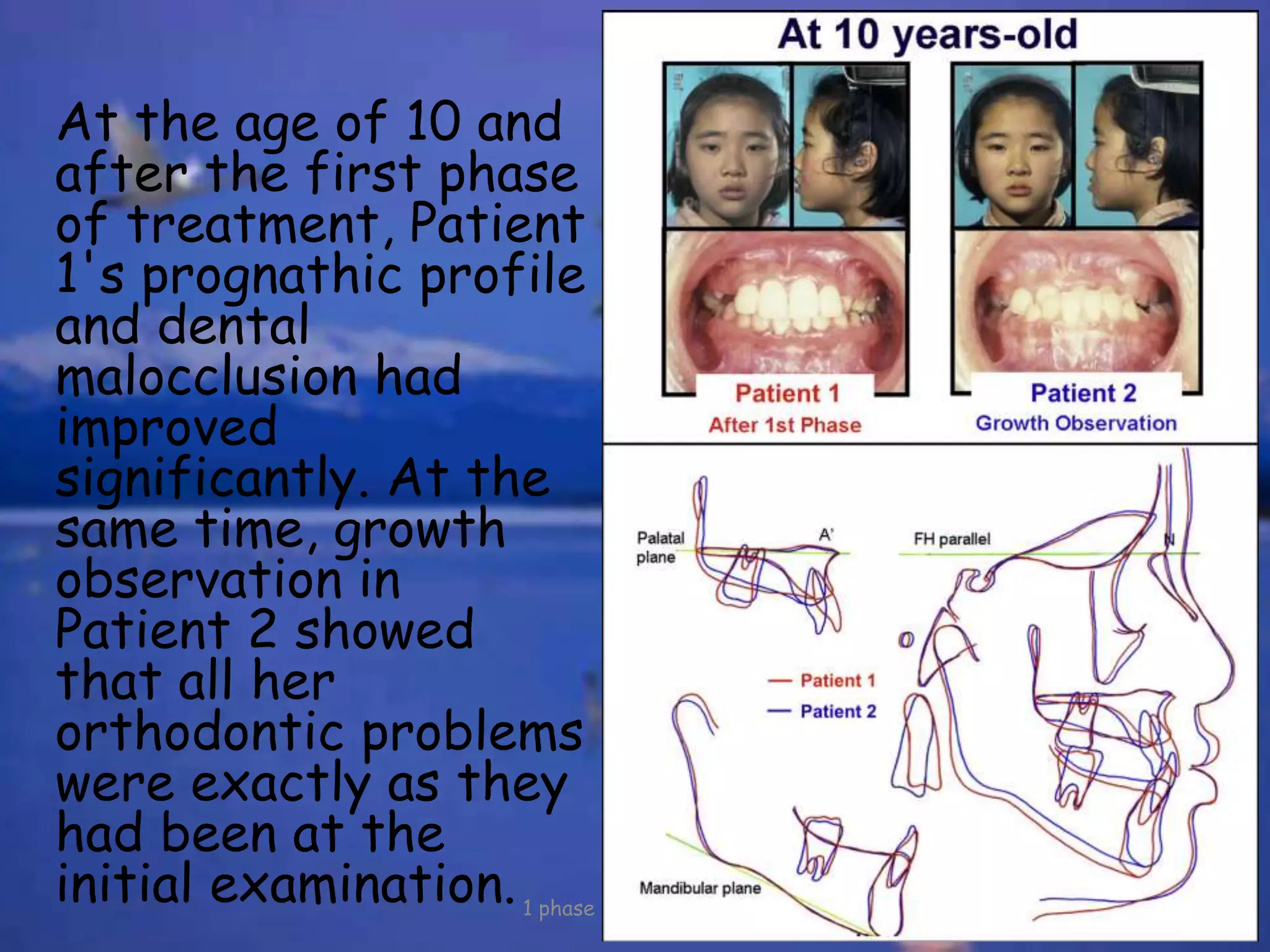 At the age of 10 and
after the first phase
of treatment, Patient
1's prognathic profile
and dental
malocclusion had
improved
significantly. At the
same time, growth
observation in
Patient 2 showed
that all her
orthodontic problems
were exactly as they
had been at the
initial examination.1 phase versus 2 phase
 