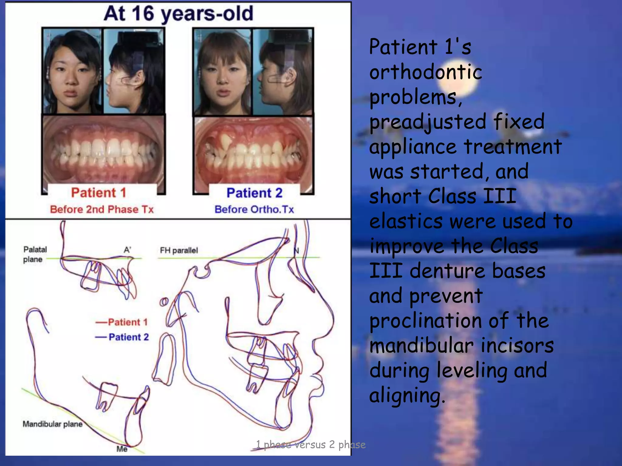 1 phase versus 2 phase
Patient 1's
orthodontic
problems,
preadjusted fixed
appliance treatment
was started, and
short Class III
elastics were used to
improve the Class
III denture bases
and prevent
proclination of the
mandibular incisors
during leveling and
aligning.
 