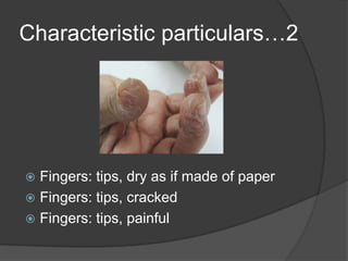Characteristic particulars…2Fingers: tips, dry as if made of paperFingers: tips, crackedFingers: tips, painful