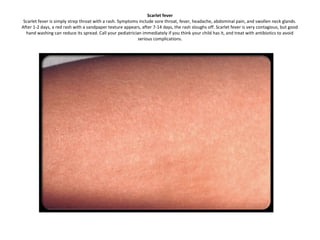 Sandpaper Textured Rash Phat ban o tre em | PPT