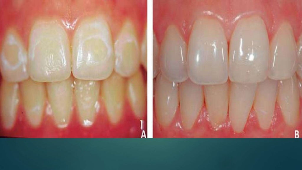 CONTROL OF WHITE SPOT LESIONS USING FLUORIDE VARNISH IN ORTHODONTIC T…