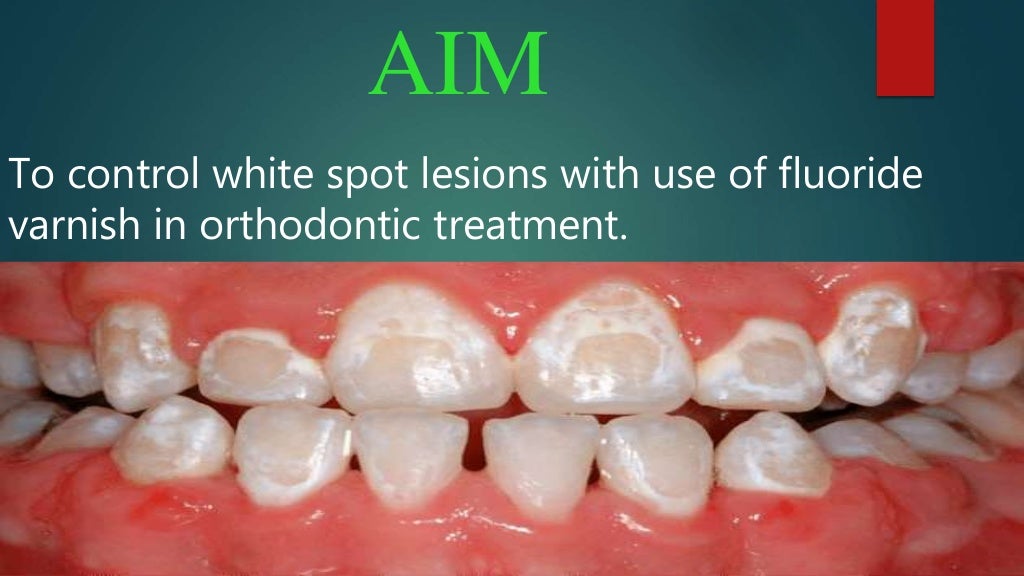 CONTROL OF WHITE SPOT LESIONS USING FLUORIDE VARNISH IN ORTHODONTIC T…
