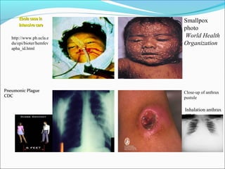 30
Ebola case inEbola case in
Intensive careIntensive care
Smallpox
photo
World Health
Organization
Close-up of anthrax
pustule
http://www.ph.ucla.e
du/epi/bioter/hemfev
apha_id.html
Pneumonic PlaguePneumonic Plague
CDCCDC
Inhalation anthrax
CDC
 