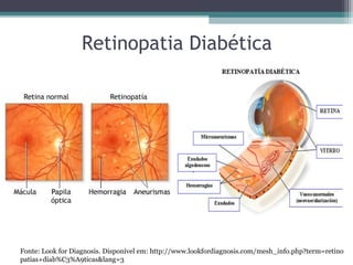 Retinopatia Diabética
Fonte: Look for Diagnosis. Disponível em: http://www.lookfordiagnosis.com/mesh_info.php?term=retino
patias+diab%C3%A9ticas&lang=3
 
