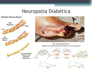Neuropatia Diabética
 