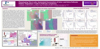 Phenotyping TILs in situ: Automated Enumeration of Intra- and Extra-Follicular
                                                                                                                           FOXP3+ Regulatory T Cells in Follicular Lymphoma
                                                                                                                           J.R. Mansfield,1 C.M. van der Loos,2 , L.S. Nelson,3 C. Rose,3 H.E. Sandison,3 S. Usher,3 J.A. Radford,3 K. M. Linton,3 R.J. Byers3
                                                                                                                           1) PerkinElmer, Hopkinton, MA; 2) Academic Medical Center, Amsterdam, Netherlands; 3) University of Manchester, UK


Summary                                                                                                                                                                                         Automated tissue and cellular segmentation                                                                                                                                                                  Clinical correlation of results
                                                                                                                                                                                                                                                                                                                                                                   Outcome                                                        Outcome                                                      Outcome
In many cancers, tumor-infiltrating lymphocytes (TILs) indicate levels of tumor                                                                                                                                                                                                     CD3 positivity, identifying T-cells, was
immunogenicity and are a strong predictor of survival. In particular, increased levels of
                                                                                                                                                                                Sample 1                                       Sample 2                                             used to identify CD3 rich and poor
                                                                                                                                                                                                                                                                                                                                                    100
                                                                                                                                                                                                                                                                                                                                                                   FOXP3 Tregs in CD3 poor areas
                                                                                                                                                                                                                                                                                                                                                                                                                   100                                                          100
                                                                                                                                                                                                                                                                                                                                                                                                                                  FOXP3 Tregs in CD3 poor areas                                FOXP3 Tregs in CD3 poor areas
regulatory T cells (Tregs) are associated with poorer prognosis in some cancers. An                                                                                                                                                                                                 areas, approximating to extra-follicular                         90                less than 25% centile                                          less than median                          90                 less than 75% centile
                                                                                                                                                                                                                                                                                                                                                                       =/> 25% centile                                                =/> median                                                   =/> 75% centile
understanding of the phenotype and spatial distribution of TILs in situ within tumor regions                                                                                                                                                                                        (green) and intra-follicular (pink)                              80                                                            80                                                           80




                                                                                                                                                                                                                                                                                                                   Survival probability (%)




                                                                                                                                                                                                                                                                                                                                                                       Survival probability (%)




                                                                                                                                                                                                                                                                                                                                                                                                                                    Survival probability (%)
would be advantageous. However, visual TIL assessment cannot easily determine the type                                                                                                                                                                                              areas, respectively. Thresholding of
                                                                                                                                                                                                                                                                                                                                                     70
                                                                                                                                                                                                                                                                                                                                                                                                                                                                                70
of lymphocyte in situ and multimarker quantitation is difficult with standard methods. Here                                                                                                                                                                                         CD3 (membrane) and FOXP3
                                                                                                                                                                                                                                                                                                                                                                                                  P=0.04           60
                                                                                                                                                                                                                                                                                                                                                                                                                                                                 P=0.00
we present a multi-marker, computer-aided event-counting method for determining the                                                                                                                                                                                                 (nuclear) was used to identify double                            60
                                                                                                                                                                                                                                                                                                                                                                                                  31                                                             36             60
phenotypes of lymphocytes in follicular lymphoma sections using a multispectral imaging                                                                                                                                                                                             FOXP3+/CD3+ Treg cells (shown as                                 50
                                                                                                                                                                                                                                                                                                                                                                                                                                                                                50
(MSI) and automated tissue segmentation and counting approach. A tissue microarray                                                                                                                                                                                                  yellow cells), FOXP3-/CD3+ cells
                                                                                                                                                                                                                                                                                                                                                     40                                                            40
                                                                                                                                                                                                                                                                                                                                                                                                                                                                                                          P=0.017
containing follicular lymphoma cores from 70 patients was stained for CD3, FOXP3 and                                                                                                                                                                                                (green) and other cells (blue) in both                                                                                                                                                      40
hematoxylin, of which 40 cores were informative for both triple staining and clinical follow-                                                                                                                                                                                       compartments.                                                    30                                                                                                                                                   3
                                                                                                                                                                                                                                                                                                                                                                                                                   20                                                           30
up. Each core was imaged using MSI and the individual staining of each marker separated                                                                                                                                                                                                                                                              20
from each other using spectral unmixing. The images were analyzed using software which                                                                                                                                                                                                                                                                                                                                                                                          20
                                                                                                                                                                                                                                                                                                                                                     10
had been trained to recognize the follicular areas based on the tissue morphology,                                                                                                                                                                                                                                                                        0   50     100                             150     200    0                                                           10
specifically based on CD3 rich (extra-follicular) and poor (intra-follicular) areas. The                                                                                                       Sample 1                                           Sample 2                                                                                                           Time
                                                                                                                                                                                                                                                                                                                                                                   Outcome
                                                                                                                                                                                                                                                                                                                                                                                                                         0   50     100
                                                                                                                                                                                                                                                                                                                                                                                                                                  Outcome
                                                                                                                                                                                                                                                                                                                                                                                                                                                   150           200                  0   50     100
                                                                                                                                                                                                                                                                                                                                                                                                                                                                                               Outcome
                                                                                                                                                                                                                                                                                                                                                                                                                                                                                                                150          200
FOXP3 status of each CD3+ TIL was then determined and the number of each Treg                                                                                                                                                                                                                                                                                                                                                       Time                                                        Time
                                                                                                                                                                                                                                                                                                                                                    100                                                            100                                                          100
(FOXP3+/CD3+) counted for both the intra- and extra-follicular tissue compartments.                                                                                                                                                                                                                                                                                FOXP3 Tregs in CD3 rich areas                                   FOXP3 Tregs in CD3 rich areas                               FOXP3 Tregs in CD3 rich areas
Results indicate that machine-learning software can be trained to accurately recognize                                                                                                                                                                                                                                                                                 less than 25% centile                                            less than median                         90                 less than 75% centile
                                                                                                                                                                                                                                                                                                                                                                       =/> than 25% centile                                             =/> than median                                             =/> than 75% centile
follicular and non-follicular regions within each core, in this instance based on abundance                                                                                                                                                                                                                                                         80                                                             80                                                            80




                                                                                                                                                                                                                                                                                                                                                                                                                                      Survival probability (%)
                                                                                                                                                                                                                                                                                                                                                                       Survival probability (%)
                                                                                                                                                                                                                                                                                                                         Survival probability (%)
of CD3 cells. MSI enabled the accurate quantitation of two immunostains in the sample
                                                                                                                                                                                                                                                                                                                                                                                                                                                                                 70
without crosstalk. The number of Tregs were determined for each core and used in Kaplan-                                                                                                                                                                                                                                                                                                                           60
Meier survival analysis, which demonstrated association of FOXP3+/CD3+ Tregs with
                                                                                                                                                                                                                                                                                                                                                    60
                                                                                                                                                                                                                                                                                                                                                                                                   P=0.21                                                                        60

favourable outcome in both the intra- and extra-follicular areas. Understanding the number                                                                                                                                                                                                                                                                                                         79                                                                            50
                                                                                                                                                                                                                                                                                                                                                                                                                   40
and location (intra- and extra-follicular) of Tregs is an assay with potentially important                                                                                                                                                                                                                                                          40
                                                                                                                                                                                                                                                                                                                                                                                                                                                                                 40
clinical prognostic implications. Thus study shows that an automated method for counting                                                                                                                                                                                                                                                                                                                                                                                                                  P=0.03
                                                                                                                                                                                                                                                                                                                                                                                                                                                                  P=0.003
Tregs can be developed for follicular lymphoma. This multimarker phenotyping and                                                                                                                                                                                                                                                                                                                                   20
                                                                                                                                                                                                                                                                                                                                                                                                                                                                                 30
                                                                                                                                                                                                                                                                                                                                                                                                                                                                                                          43
counting approach shows the potential for broad applicability in the enumeration of a wide
                                                                                                                                                                                                                                                                                                                                                    20
                                                                                                                                                                                                                                                                                                                                                                                                                                                                  4
                                                                                                                                                                                                                                                                                                                                                                                                                                                                                 20
range of specifically phenotyped TILs in situ in many solid tumors.
                                                                                                                                                                                                                                                                                                                                                                                                                    0                                                            10
                                                                                                                                                                                                                                                                                                                                                     0
                                                                                                                                                                                                                                                                                                                                                                                                                         0   50     100                            150    200         0   50     100           150             200
                                                                                                                                                                                                                                                                                                                                                          0   50     100                             150    200
                                                                                                                                                                                                                                                                                                                                                                                                                                   Time                                                         Time
                                                                                                                                                                                                                                                                                                                                                                    Time
                                                                                                                                                                                                             Sample 1                                Sample 2
                                                                                                                                                                                                             Extra-follicular cells:1473             Extra-follicular cells: 1917
                                                                                                                                                                                                                                                                                                  53 samples from 40 patients were automatically analyzed using this methodology and the number of FOXP3+/CD3+ Treg cells in each determined, in both T-cell (CD3+) rich
  Multispectral imaging technology                                                                                         Morphologic and cellular segmentation                                             CD3+/FOXP3-: 13.9%                      CD3+/FOXP3-: 19.66%                          and poor areas. The number of Tregs cells were used in Kaplan-Meier survival analysis, demonstrating association of higher numbers of Tregs with favourable outcome in
                                                                                                                                                                                                             CD3+/FOXP3+: 12.3%                      CD3+/FOXP3+: 0.66%
                                                                          Spectrum from                                                                                                                      Survival: 171+ months                   Survival: 54 months
                                                                                                                                                                                                                                                                                                  both T-cell rich (extra-follicular) and poor (intra-follicular) areas (data shown with data split at 25th percentile, median & 75th percentiles for CD3+/FOXP3+ Treg score). This
                      • Images at different
                                                                          nucleus with both
                                                                          hematoxylin and
                                                                                                                            Breast cancer ER/PR                                                                                                                                                   meant patients were divided into groups determined by their Treg numbers using these three statistics as a threshold; . Kaplan-Meier demonstrated that patients with Treg
                                                                          DAB
                        wavelengths
                                                                                                                            co-expression assay                                                                                                                                                   numbers in the top 75%, 50% and 25% all had significant survival advantages over those with lower numbers when divided into two groups based on these proportions
                      • Assemble the images
                        into a data “cube”
                      • Spectrum at every (x,y)
                        pixel                                                                                              RGB representation                                                                           Multispectral imaging of triplex-
                                                                                                                                                                                                                                                                                                                                                                                                   Conclusions
                                                                                                                           of spectral cube

                                                                                                                                                                                                                        stained follicular lymphoma
                                                             Spectrum from                           Spectrum from                                           With cancer mask
                                                                                                                                                                                                                                                                                                                                                                     • Multispectral imaging enabled the quantitation of two immunostains (CD3
  Nuance® and Vectra™
                                                             membrane with
                                                             just red stain
                                                                                                     stroma with just
                                                                                                     hematoxylin
                                                                                                                                                                                                                         RGB representation of multispectral dataset                                                                                                   & FOXP3) in intra- and extra-follicular compartments in follicular
   Multispectral Imaging
                                                                                                                                                                                                                                                                                                                             FOXP3                                     lymphoma
                                                            RGB Representation of Spectral Cube
          Systems
                                                                                                                                                                                      With cancer mask and
                                                                                                                                                                                                                                                                                                                                                                     • FOXP3+ Tregs were automatically counted and used in Kaplan-Meier
                                                                                                                                                                                      nuclear segmentation
                                                                                                                                                                                                                                                                                                                                                                       survival analysis, demonstrating association with good outcome
                                                                                              Unmixed DAB
                                                                                                                                                                                                                                                                                                                                                                     • Automated multiplexed tissue cytometry analyses are feasible for routine
                                                                                              Component                  1) Automated user-trained
                                                                                                                            morphologic segmentation
                                                                                                                                                                                                                                                                                                                                                                       clinical studies and work with many multiplexed IHC staining
  Spectra of pure chromogens
                                                                                                                            using inForm™ Tissue Finder
  collected from single- stained
  sections
                                                                Unmixed Red
                                                                Component                 Once unmixed,                                                                                                                                                                                                                                                                methodologies.
                                                                                                                                                                                                                                                                                                                                                                     • The enumeration of FOXP3 +’ve T cells in these clinical samples was
                                      Unmixed Hematoxylin                                 stains can be                                         2) Cellular segmentation
                                      Component                                                                         Red = cancer mask
                                                                                          measured                                                 (nuclear, cytoplasmic or
                                                                                                                                                                                                                                                                                                                       CD3
                                                                                                                        Green = cancer nuclei
                                                                                          accurately.                                              membrane)
                                                                                                                        Blue = background
                                                                                                                                                                                                                                                                                                                                                                       effective and easy to perform.

                                                                                                                                                                                                                                                                                              PerkinElmer, Inc., 68 Elm Street, Hopkinton, MA USA (800) 762-4000 or (+1) 203 925-4602 www.perkinelmer.com
 