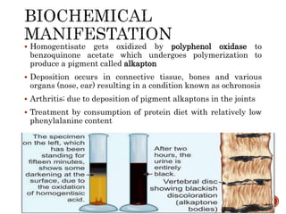  Homogentisate gets oxidized by polyphenol oxidase to
benzoquinone acetate which undergoes polymerization to
produce a pigment called alkapton
 Deposition occurs in connective tissue, bones and various
organs (nose, ear) resulting in a condition known as ochronosis
 Arthritis; due to deposition of pigment alkaptons in the joints
 Treatment by consumption of protein diet with relatively low
phenylalanine content
 